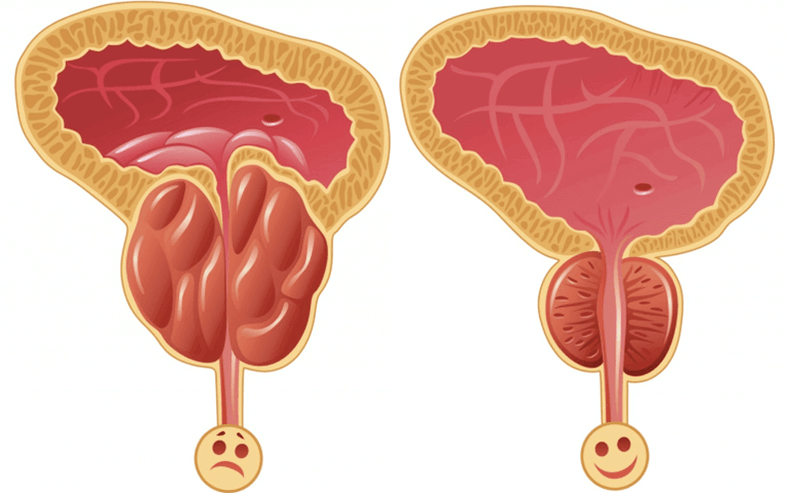 Αιτίες προβλημάτων ισχύος στους άνδρες